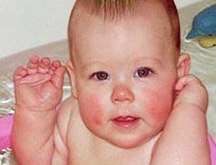 Лечение диатеза у детей