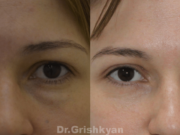 Блефаропластика: важный шаг к взгляду вашей мечты