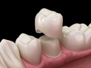 Разновидности коронок для зубов