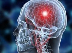 Рассеянный склероз: первые признаки болезни