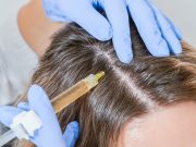 Плазмотерапия для волос: эффективное решение проблемы облысения