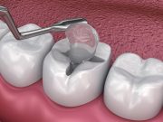 Герметизация фиссур у детей: эффективные методы и рекомендации