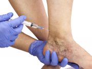 Склеротерапия вен нижних конечностей: типы, показания и противопоказания