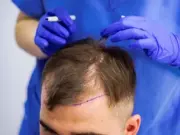 Пересадка волос: решение, подготовка и противопоказания