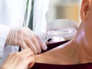 Удаление новообразований методом электрокоагуляции